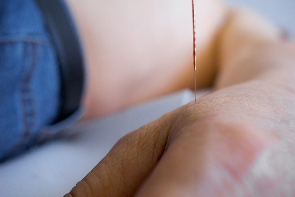 A patient during an acupuncture treatment